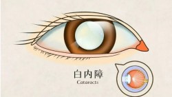 如何预防白内障