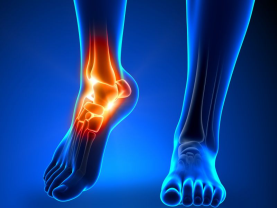 踝关节骨性关节炎的类型有哪些